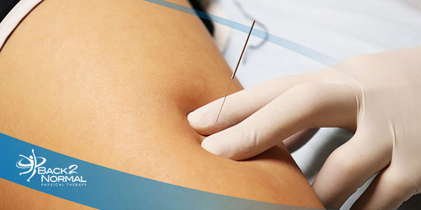 Dry Needling for Pain Relief & Recovery