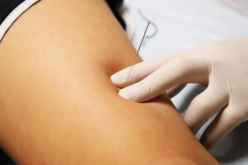 dry needling for arm pain St. Petersburg