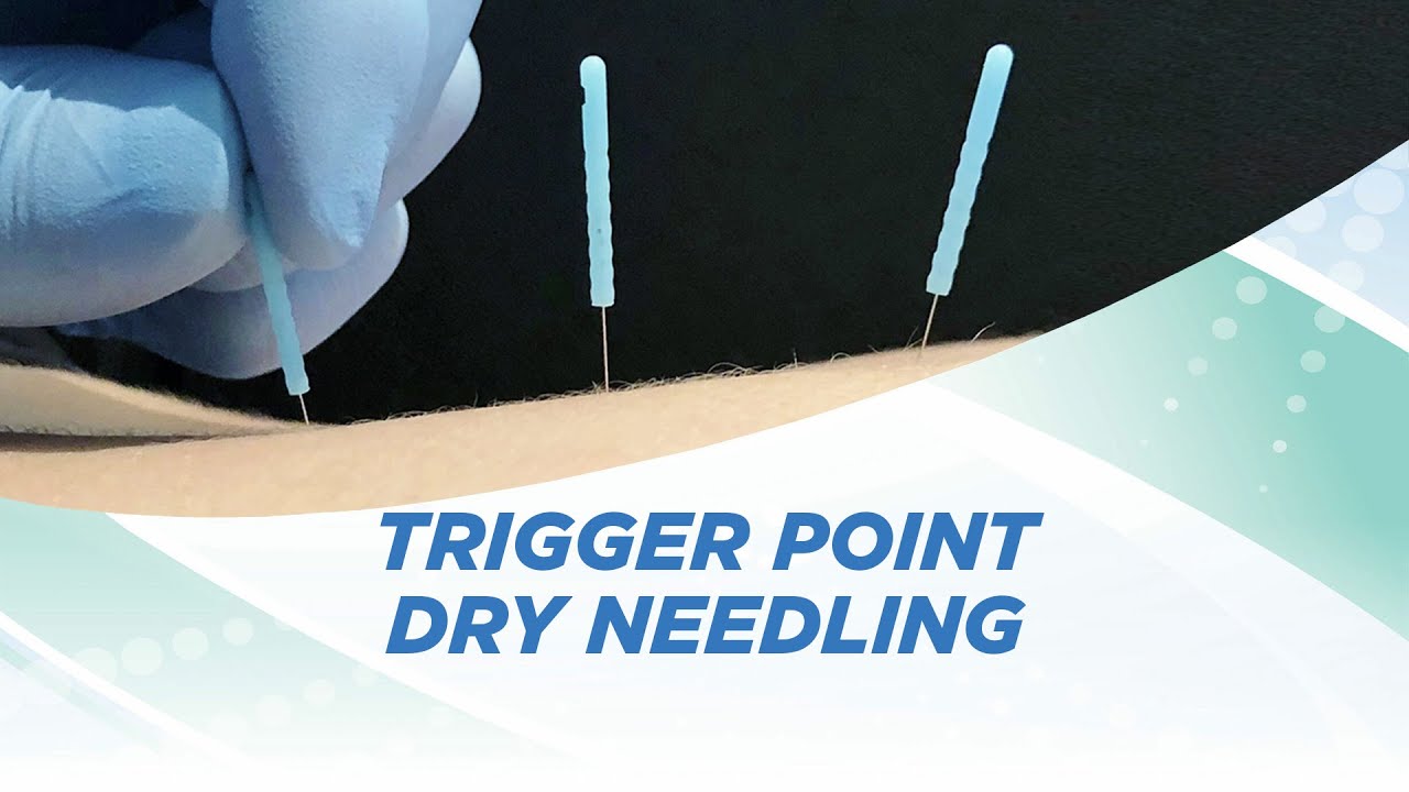 Trigger Point Dry Needling