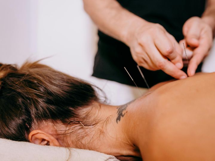 Dry Needling for headache St. Petersburg, FL