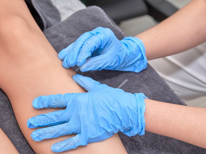 dry needling for leg pain St. Petersburg